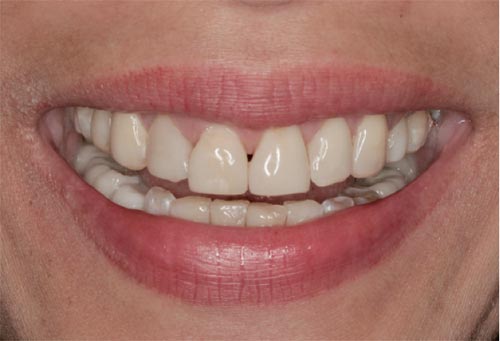 Temporary Veneers