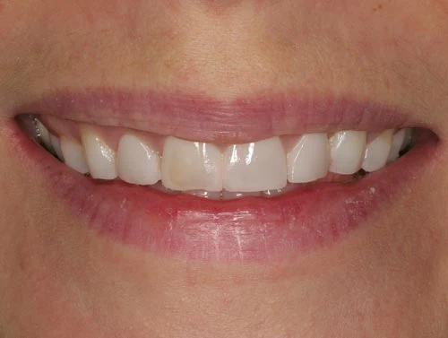 san francisco porcelain veneers