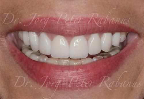 Best Porcelain Veneers San Francisco 1