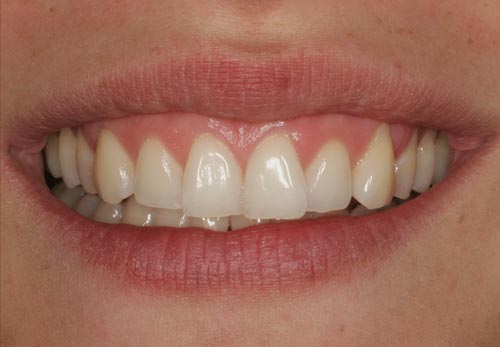 Aesthetic Shortcomings of Teeth