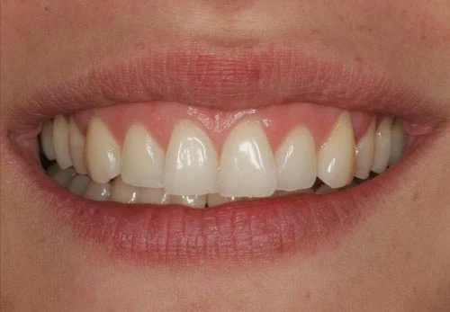 Aesthetic Shortcomings of Teeth