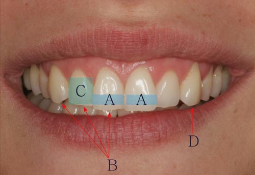 Highlighted Aesthetic Shortcomings of Teeth