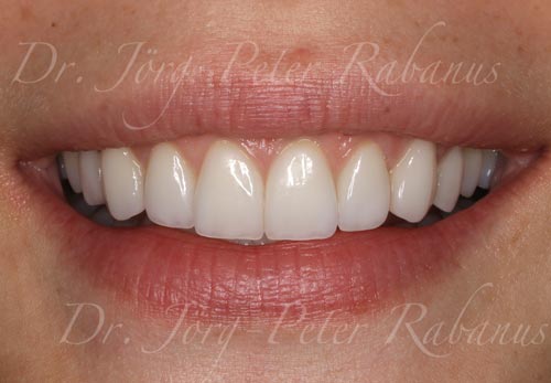 Corrected Aesthetic Dental Concerns of Dental Patient