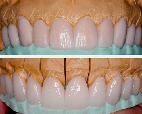 From Wax-Up to Porcelain Veneers