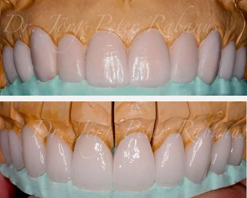From Wax-Up to Porcelain Veneers