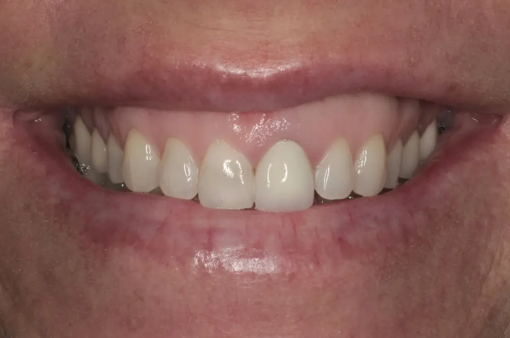 porcelain veneers san francisco