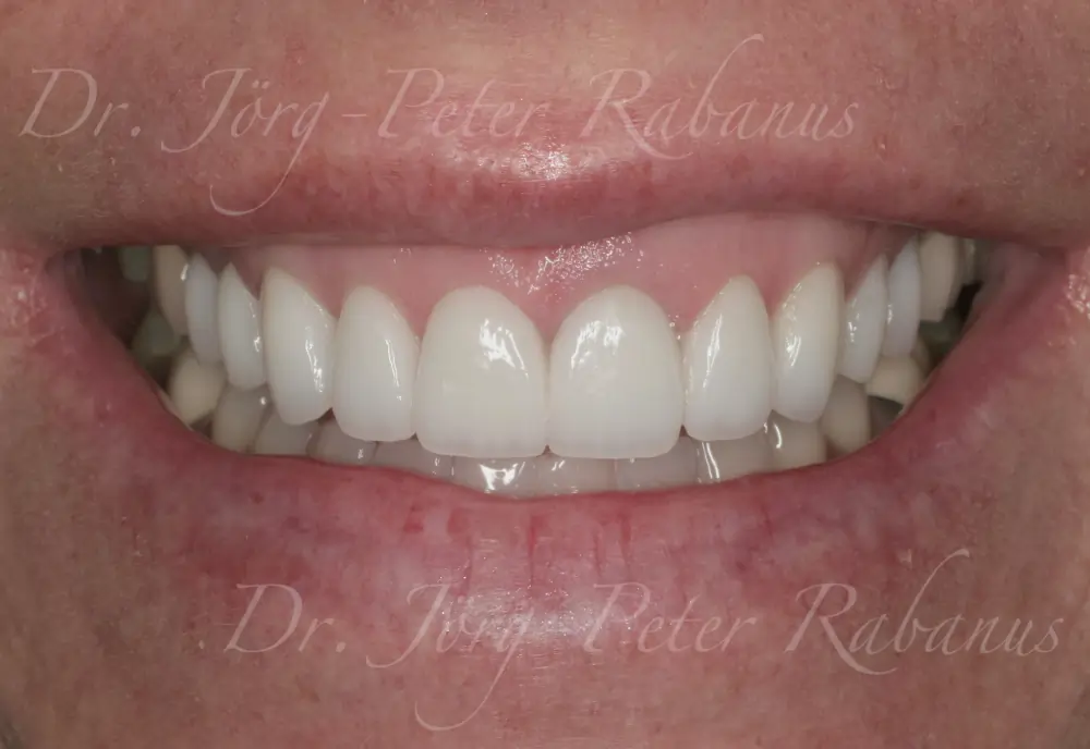 natural porcelain veneers san francisco