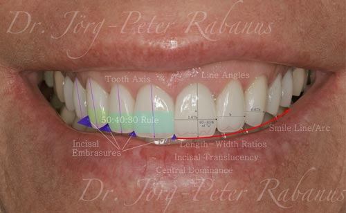 Porcelain Veneers Smile Design 1