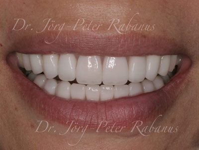 Severely stained teeth after treatment with dental porcelain veneers