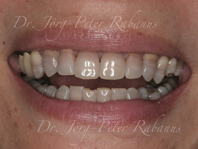 Stained Teeth Before Porcelain Veneers