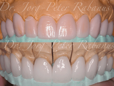 Steps Towards a New Smile with Porcelain Veneers