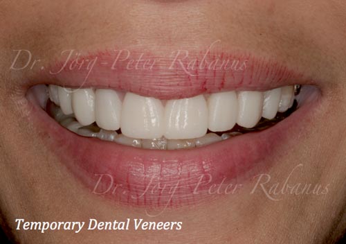 Temporary Dental Veneers