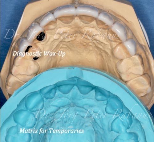 Diagnostic Wax-Up for Porcelain Veneers