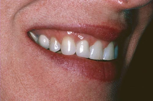 worn teeth before porcelain veneers