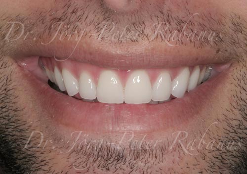 best porcelain veneers san francisco after