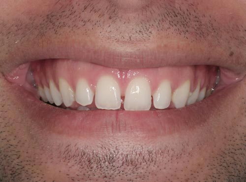 best cosmetic dentist san francisco porcelain veneers