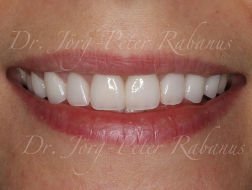 small teeth with porcelain veneers