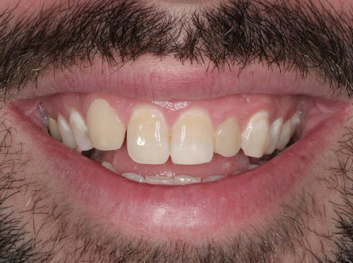 best porcelain veneers for missing teeth