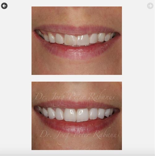 Porcelain Veneers