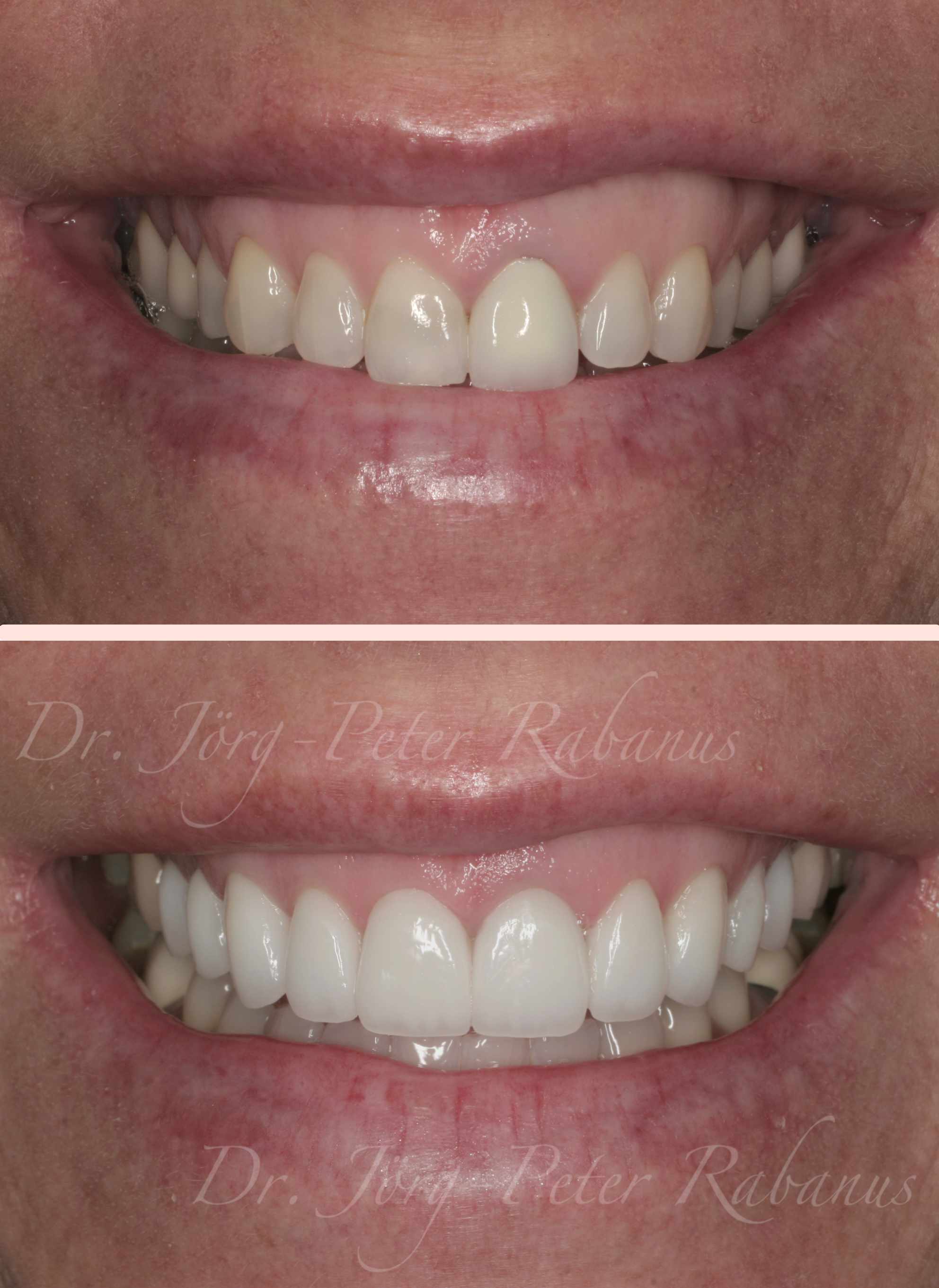 porcelain veneers