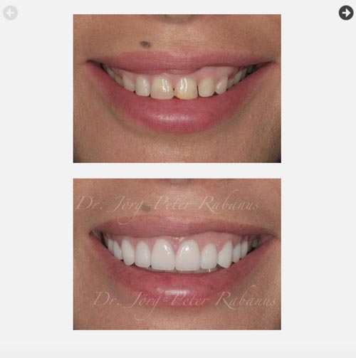 Porcelain Veneers 2