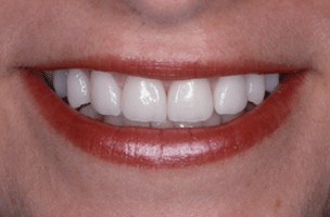 porcelain_veneers_4