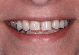 porcelain_veneers_3