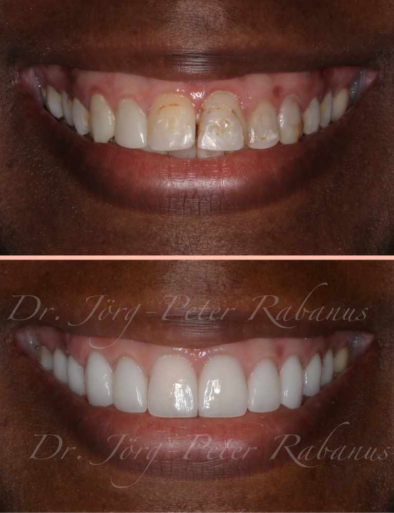 porcelain veneers san francisco change lives