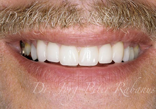 worn and stained teeth after cosmetic dentistry