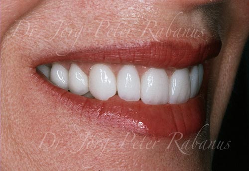 worn teeth restored with porcelain veneers